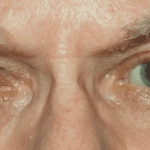 cac-benh-ve-mat-o-nguoi-lon-tuoi